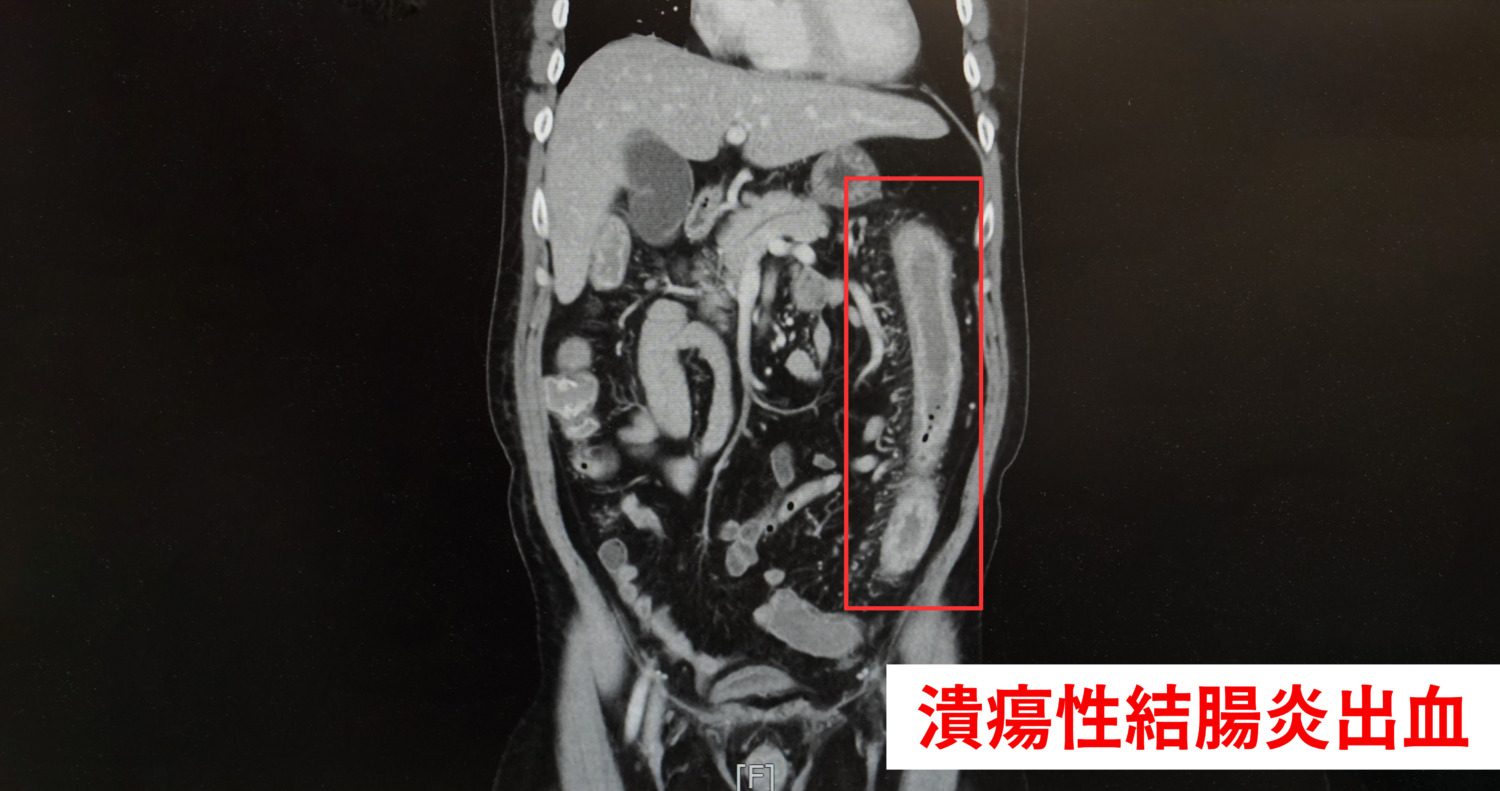 蘇俞豪醫師表示，潰瘍性結腸炎可能導致結腸出血，嚴重時恐休克危及生命，發作期應低渣飲食並規律服藥，以降低復發風險。（圖/記者林照東翻攝）